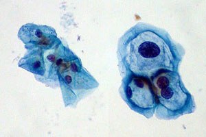 Hpv large