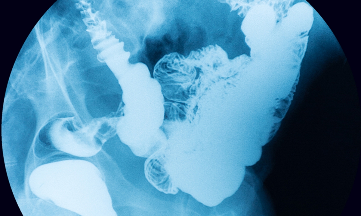 HPV vaccine crucial to stalling anal cancer rise - Featured Image