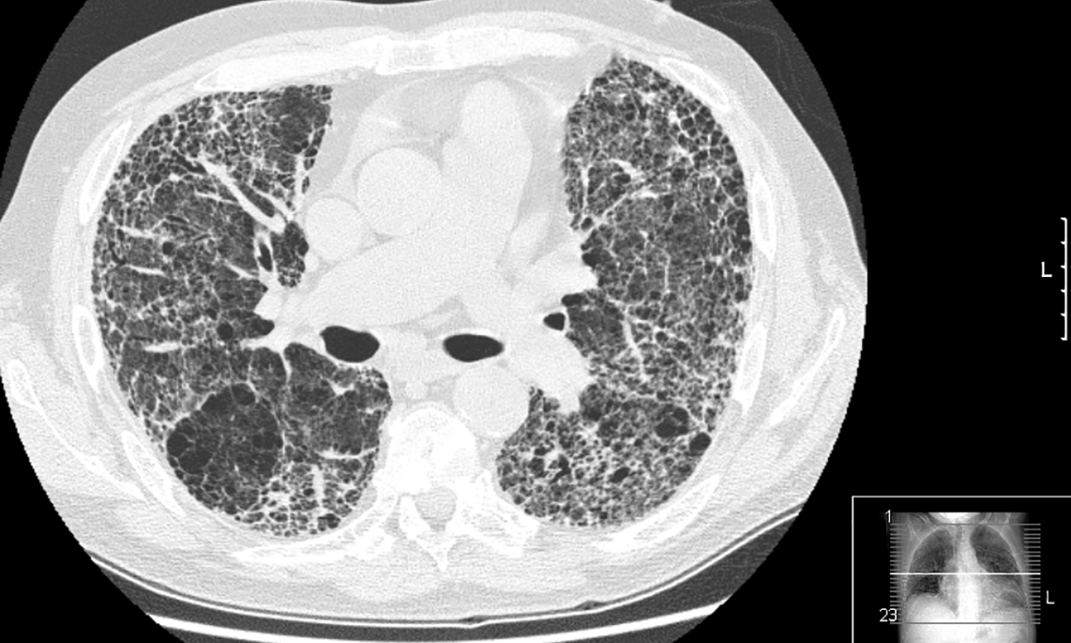 Idiopathic pulmonary fibrosis: promise on the horizon - Featured Image