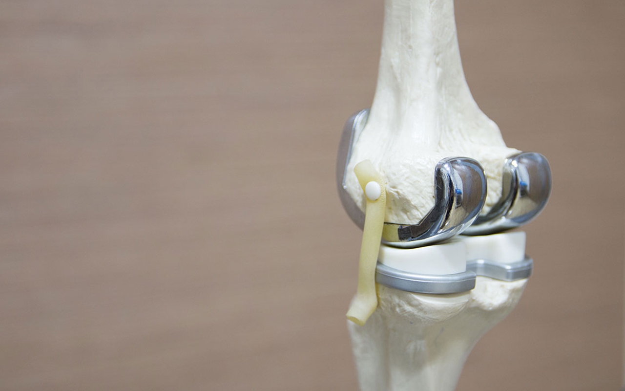 Inpatient knee replacement rehab: low value or undervalued? - Featured Image