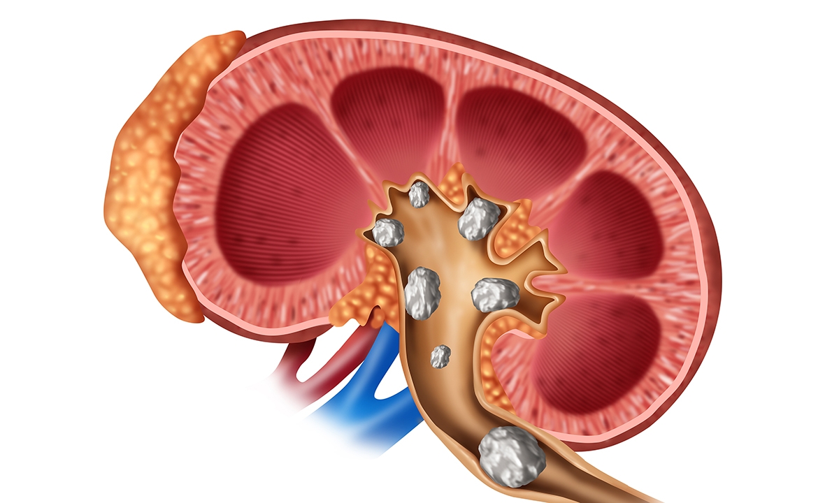 Kidney stones chasing the holy grail of dissolution 514