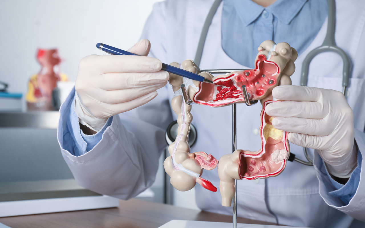 Colorectal cancer an increasing risk for younger people  - Featured Image