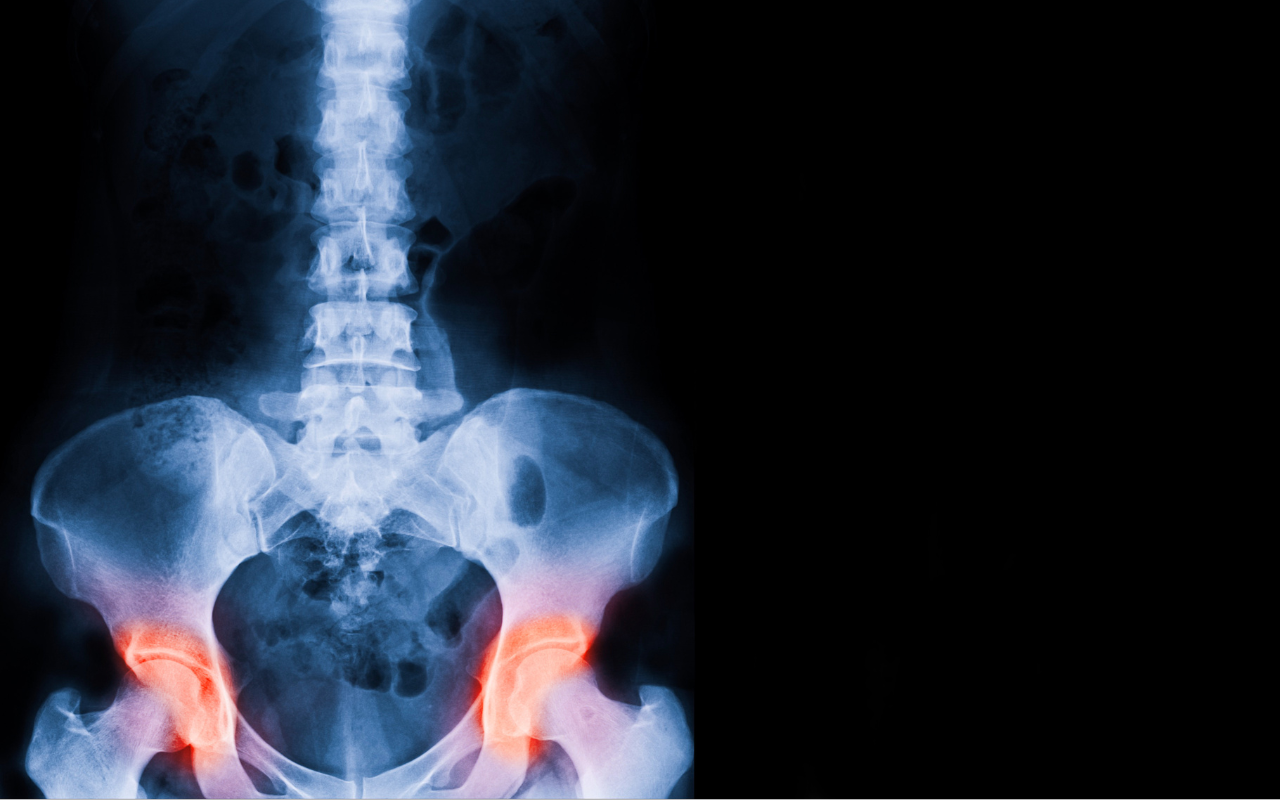 New guidelines for osteoporosis management - Featured Image