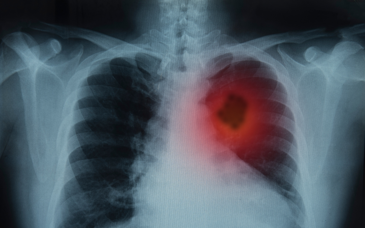 Australia’s new lung cancer screening program has chosen simplicity over equity, and we’re concerned - Featured Image