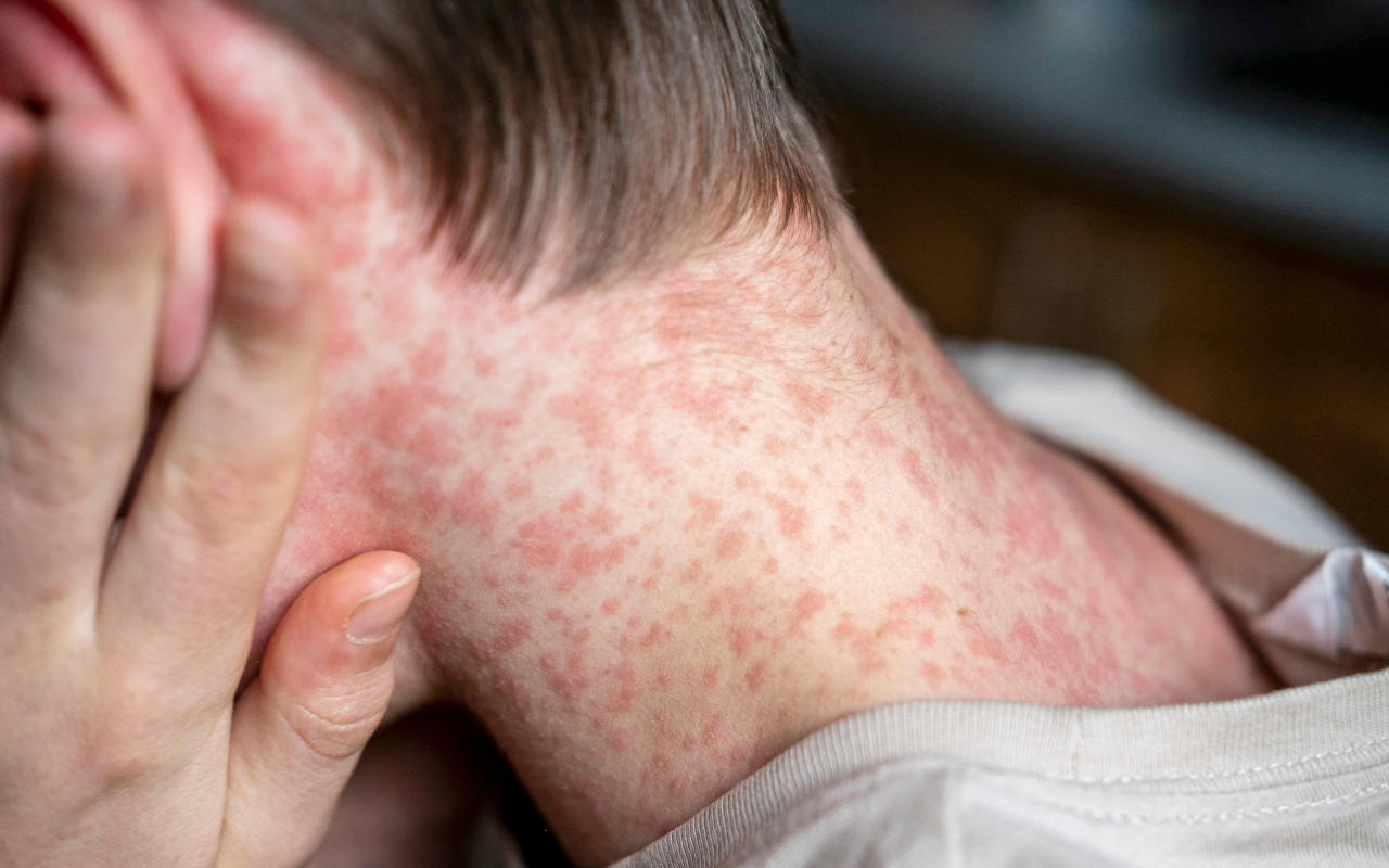 New measles cases in Queensland show ‘herd immunity’ is more important than ever - Featured Image