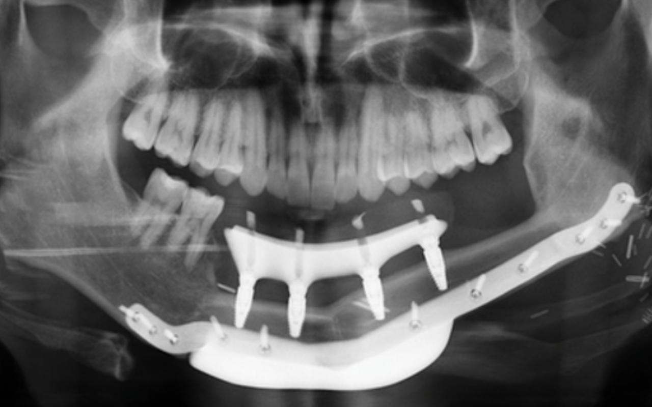 Jaw reconstruction surgery