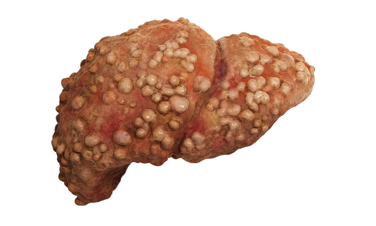 Liver cancer catching it early the key to survival 390