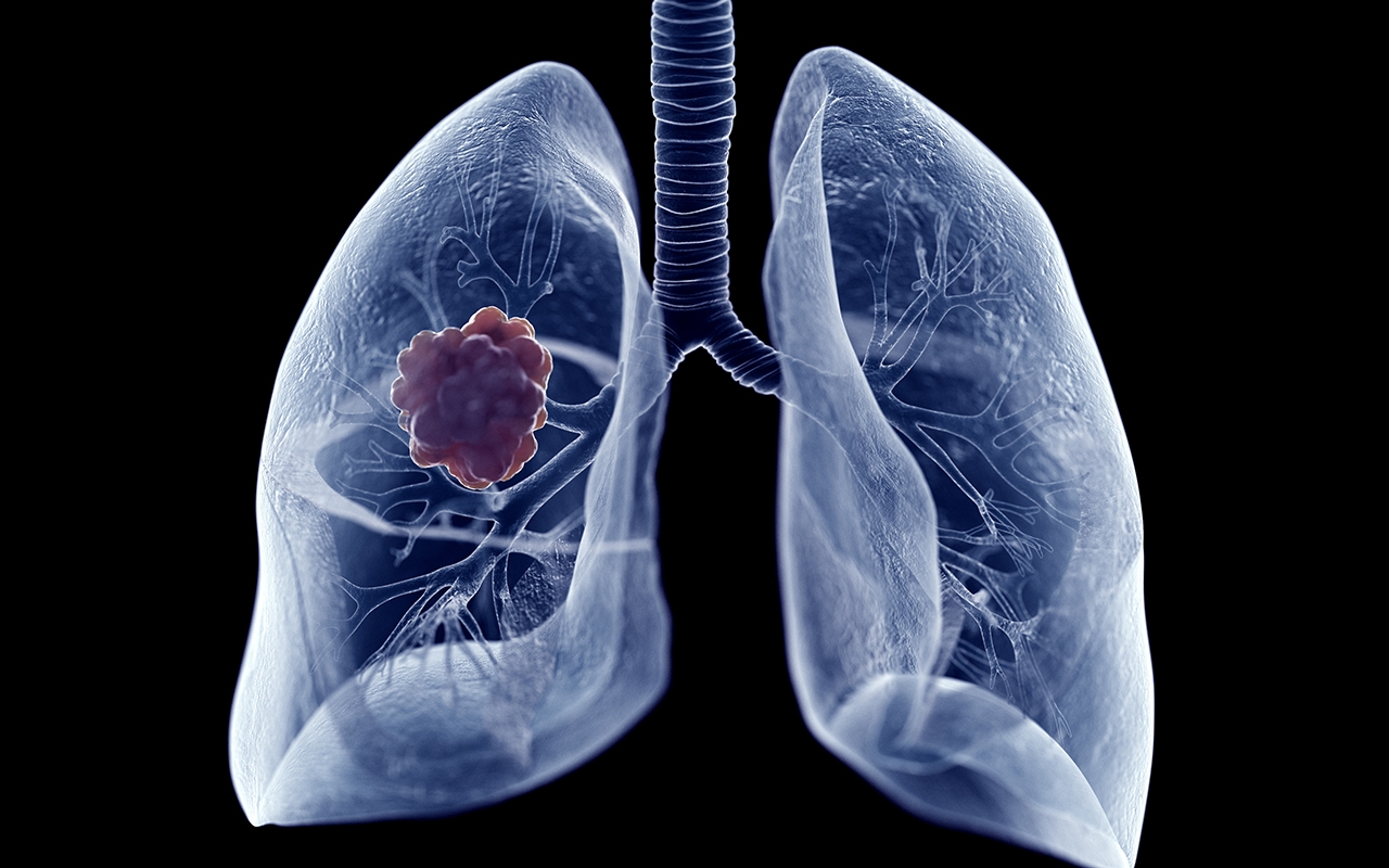 Lung cancer: pay more attention to never smokers - Featured Image