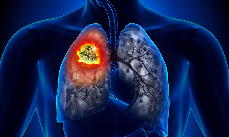 Lifting rural lung cancer survival - Featured Image