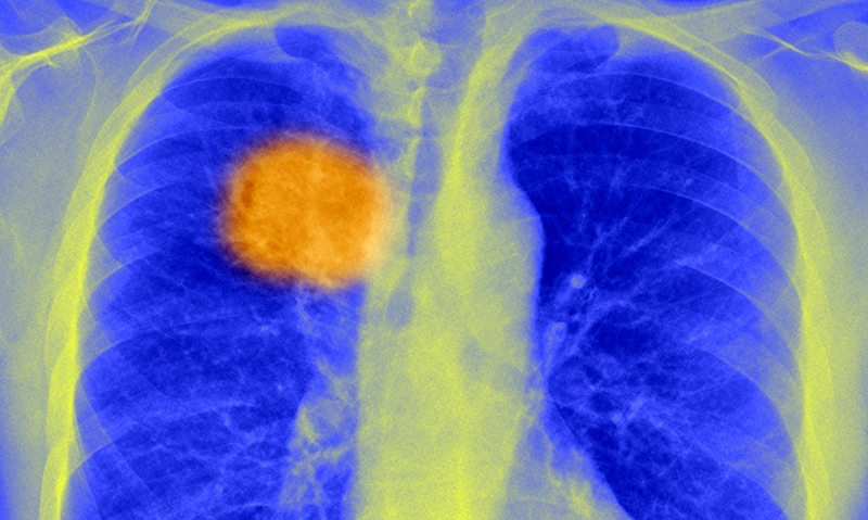 Lung