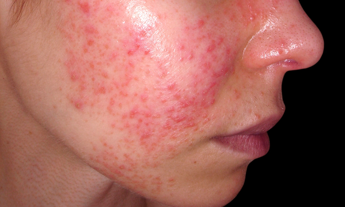 Lupus registry vital to treatment progress - Featured Image