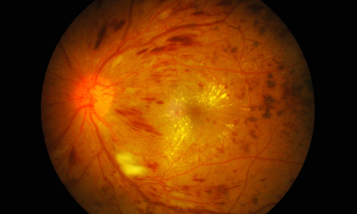MBS listing for retinal cameras a win for common sense - Featured Image