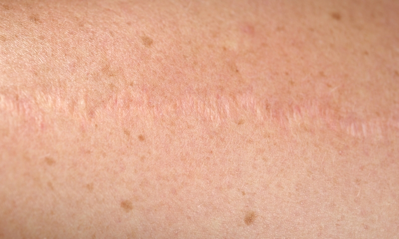 Melanoma scar