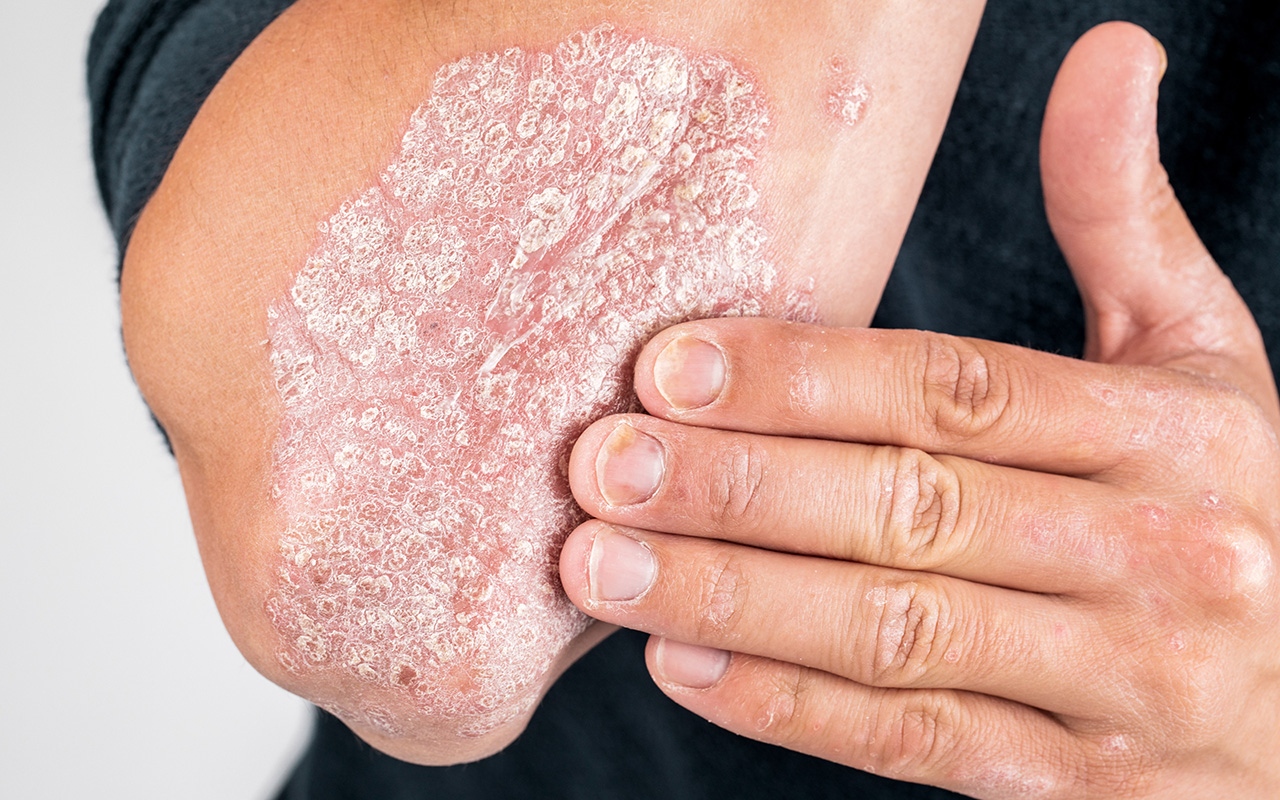 More to psoriasis than a skin condition 524