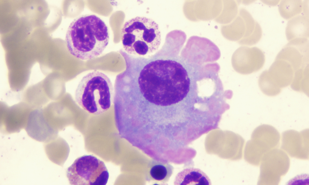 Multiple myeloma survivability on the rise 675