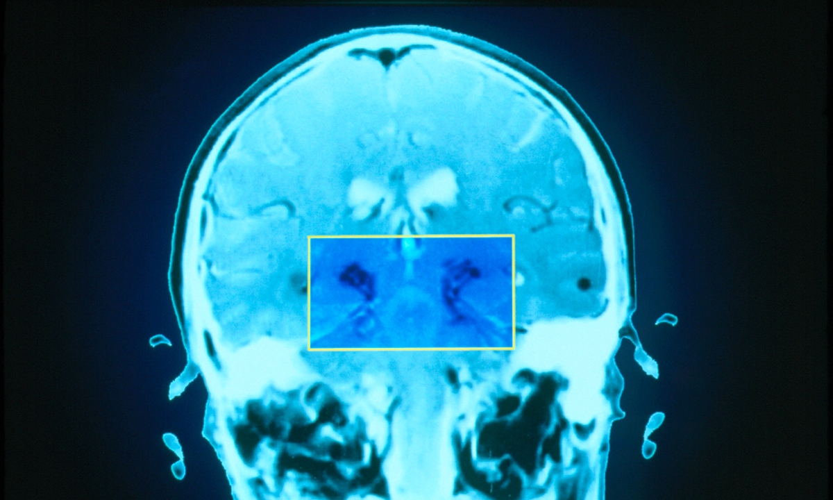 New parkinsons test promising 483