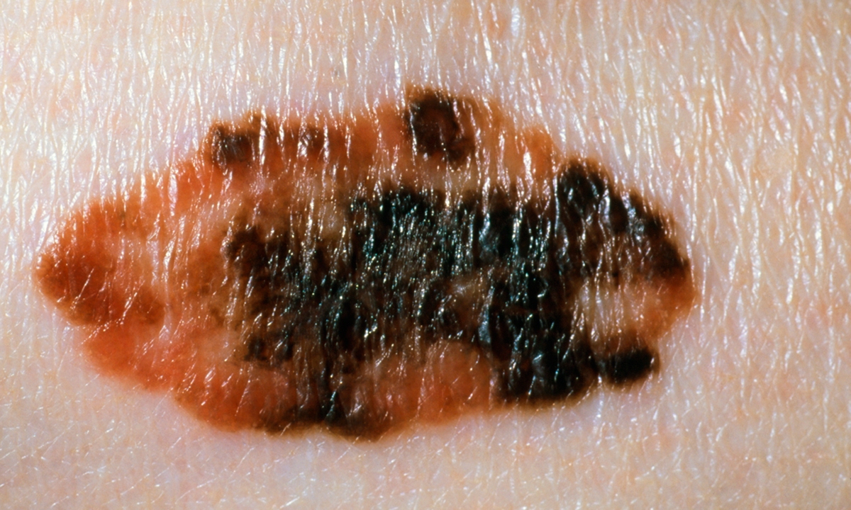 Ninety-second mole check a must in pregnancy - Featured Image