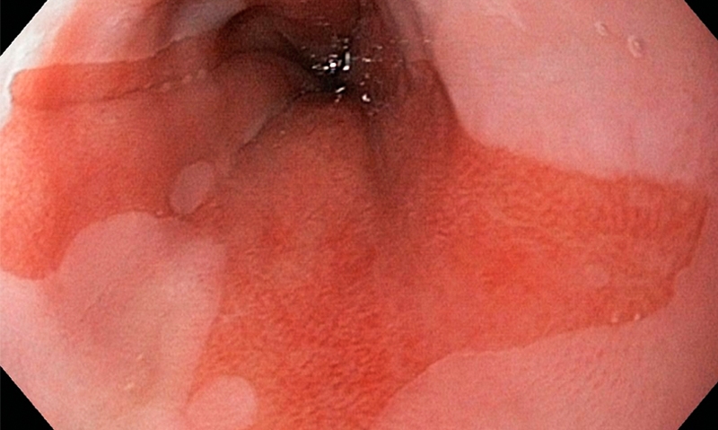 Ablation treatment doubts - Featured Image