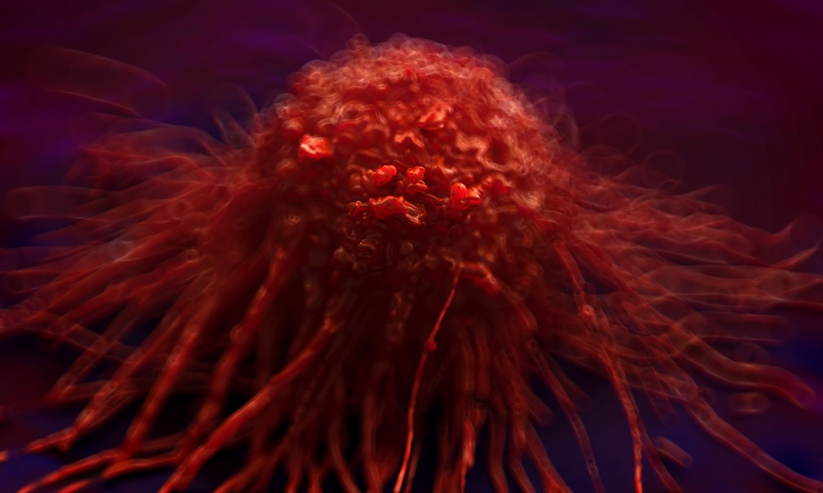 Pancreatic cancer 0