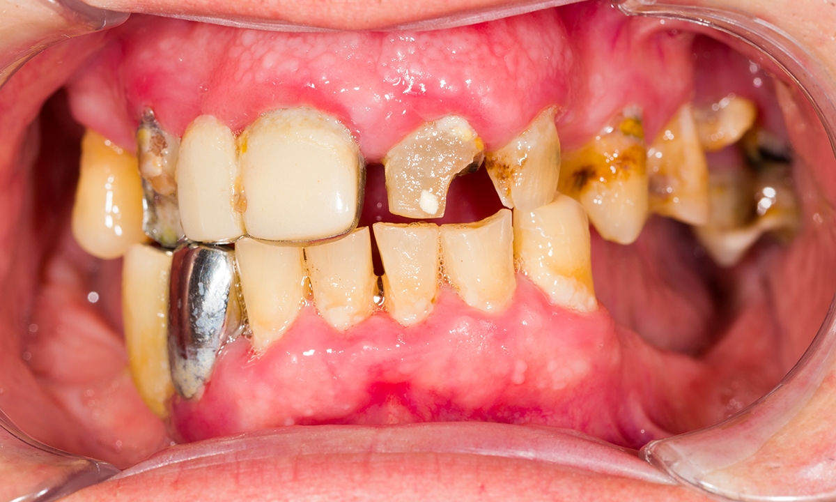 Poor oral health a danger for elderly frail 742