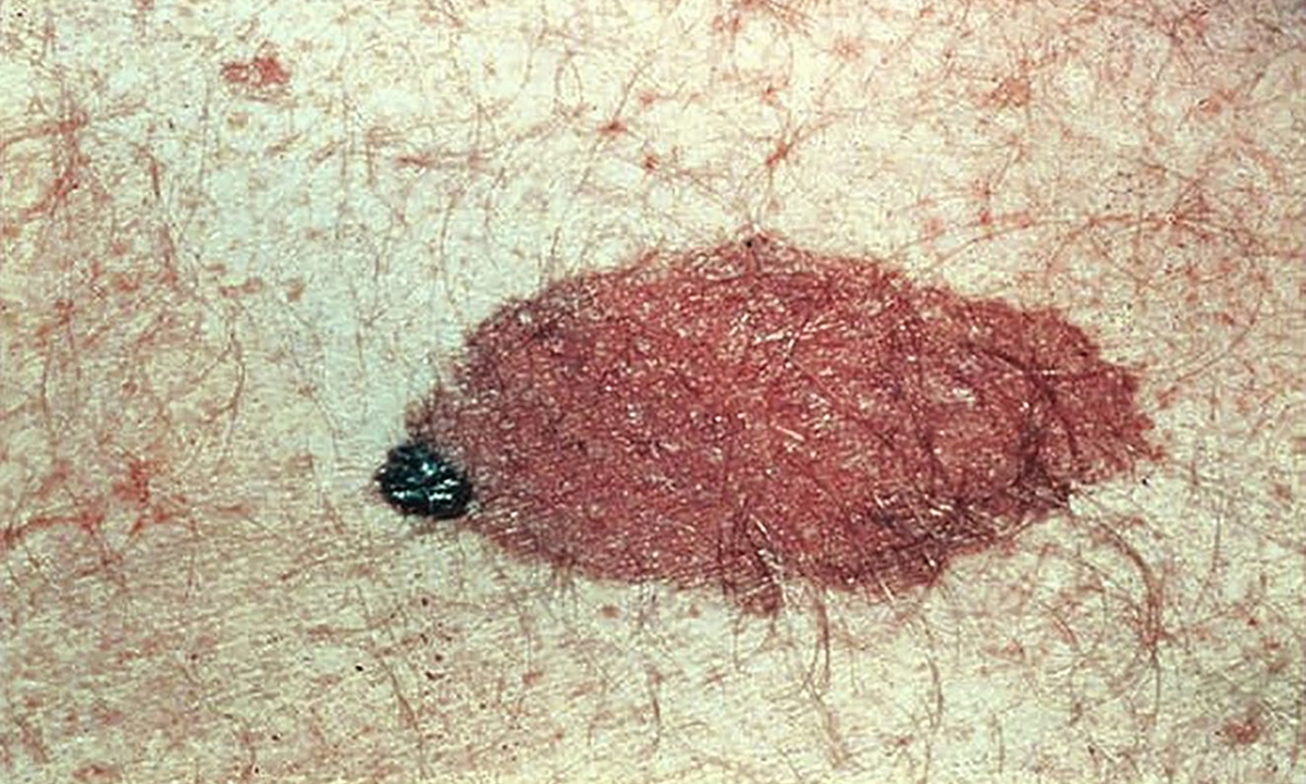 Practical guide to atypical melanomas 641