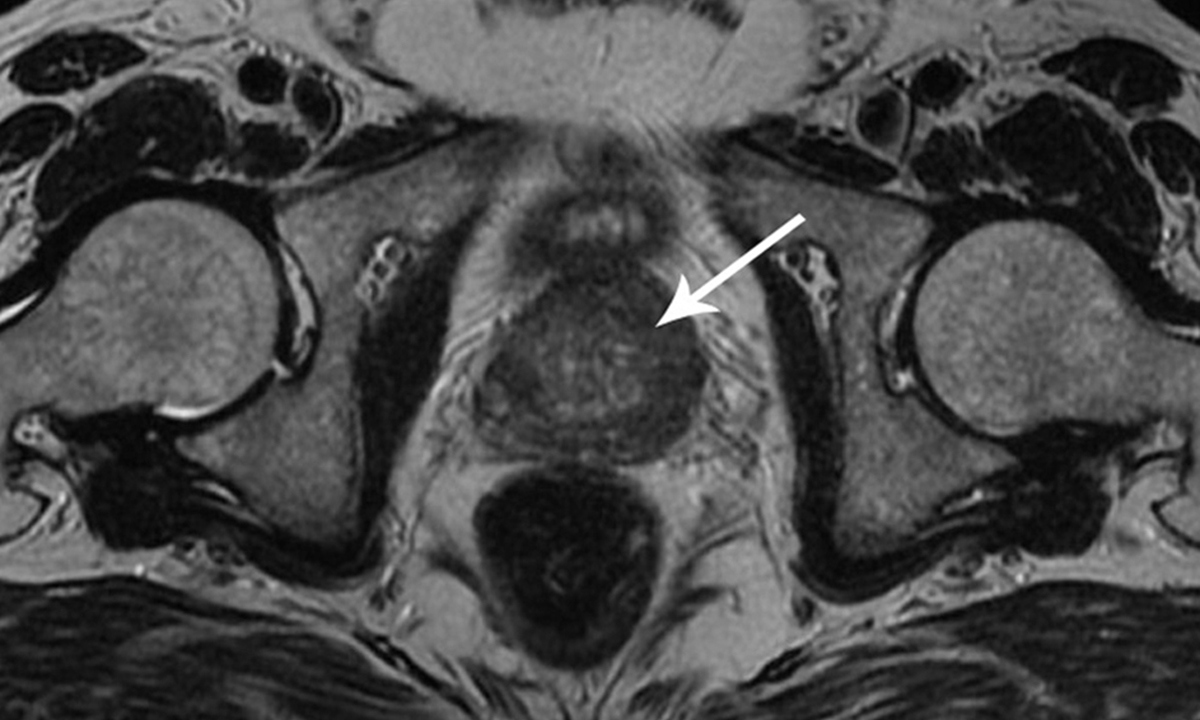 Prostate cancer mri