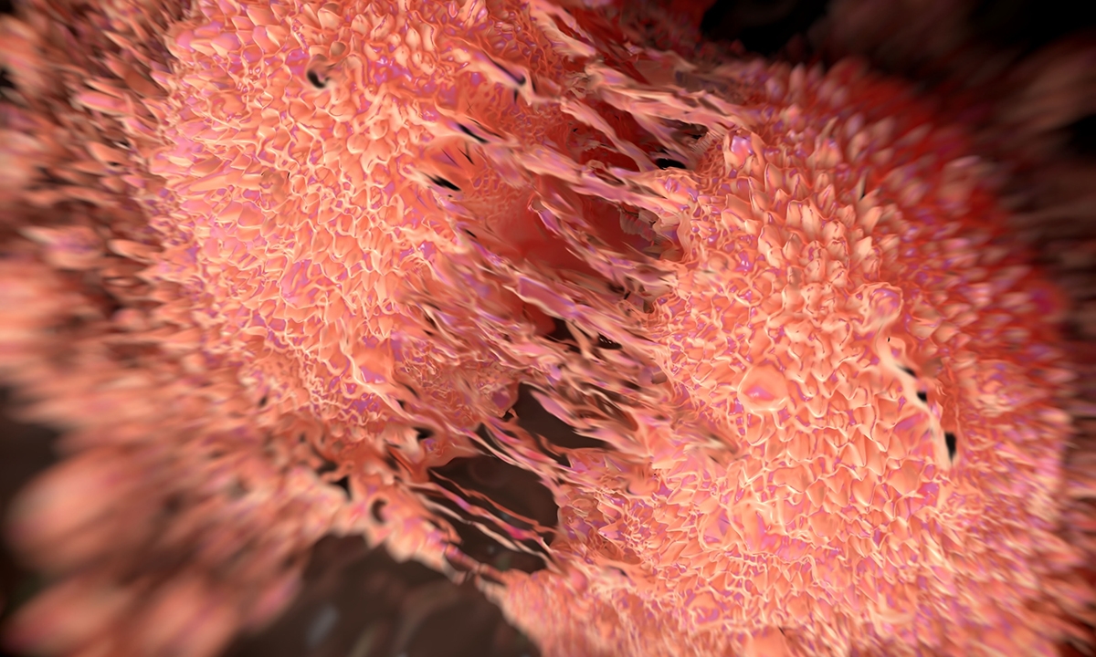 Prostate cancer: urologists fight back - Featured Image