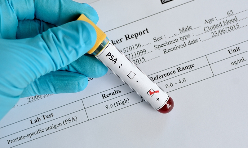 New guidelines but prostate testing still complex - Featured Image