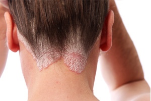 Aggressive therapy cuts MI risk in psoriasis - Featured Image