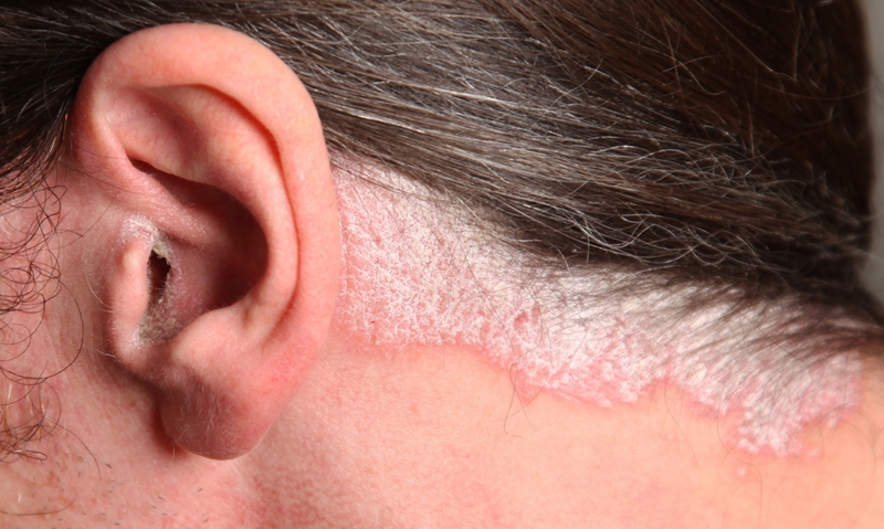 Psoriasis link to major comorbidities - Featured Image
