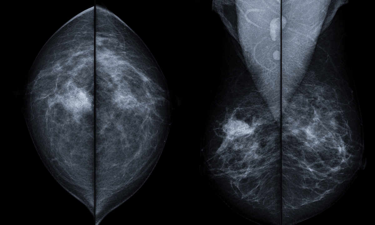 Radiotherapy for breast cancer: a fast-evolving field - Featured Image