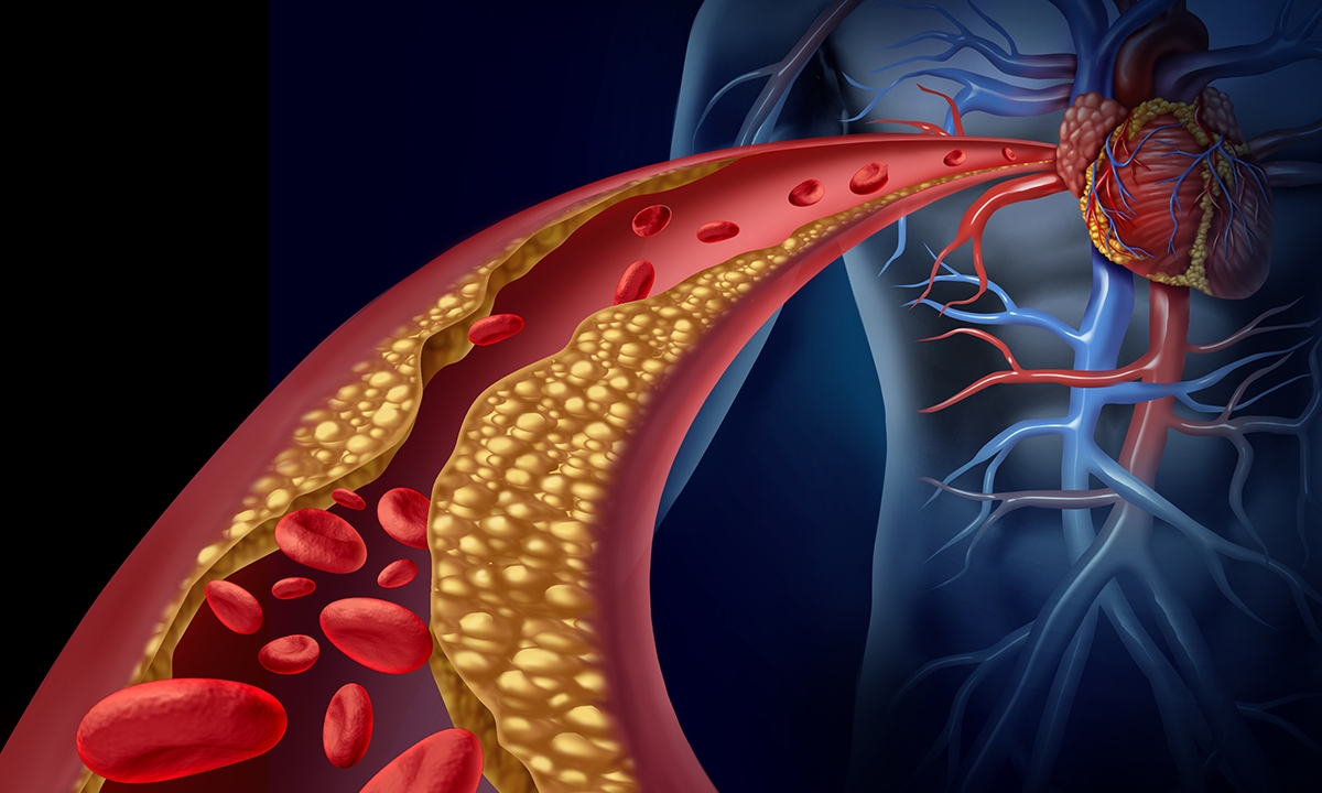 Refocusing on familial hypercholesterolaemia 525