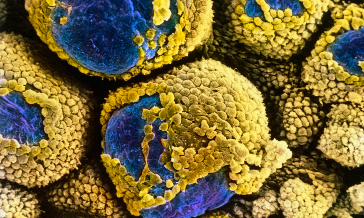 Research sparks PCOS label debate - Featured Image