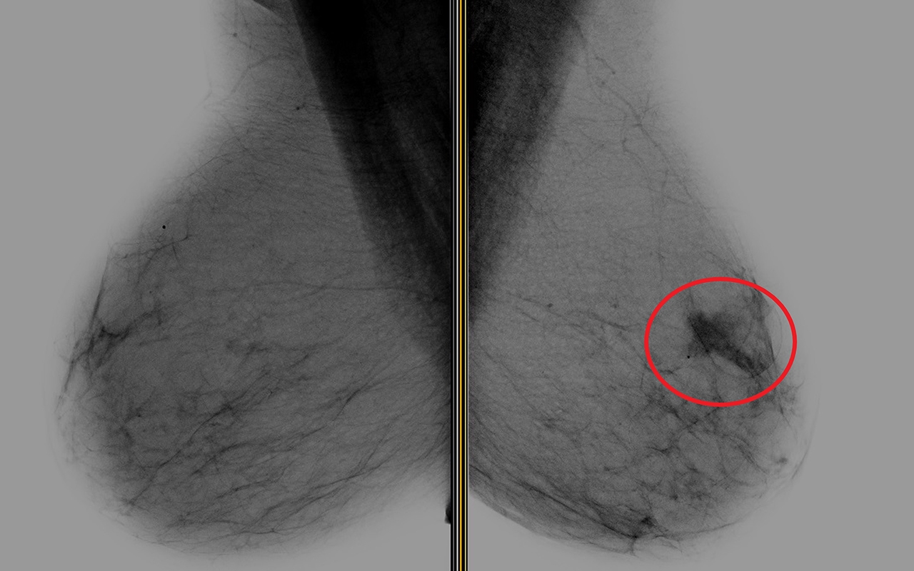 Screening 3d mammograms will we overdiagnose indolent breast cancers 106