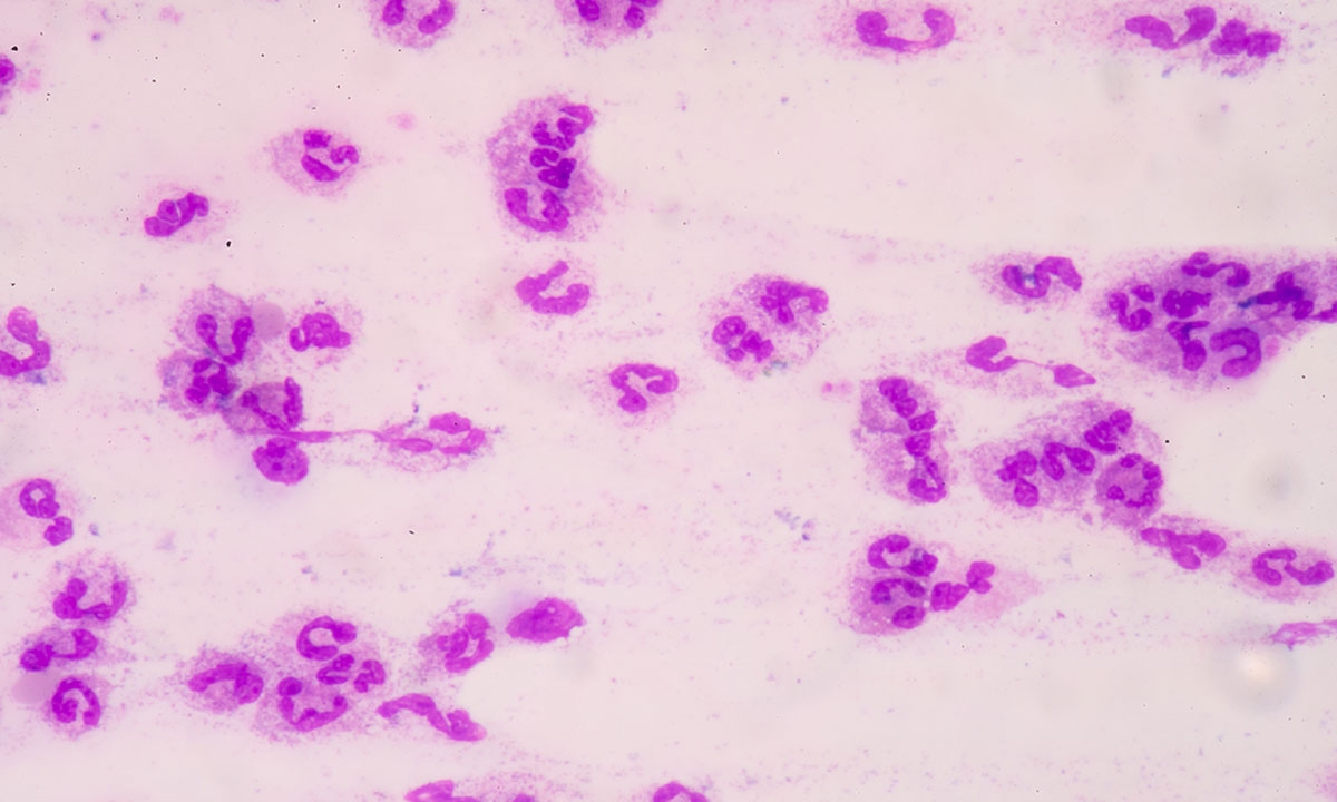 Sepsis: learn the signs and document - Featured Image