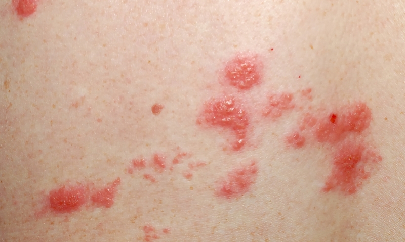 Shingles