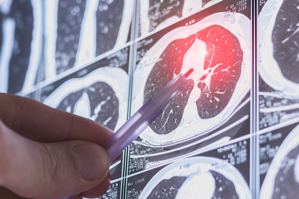 Pulmonary fibrosis