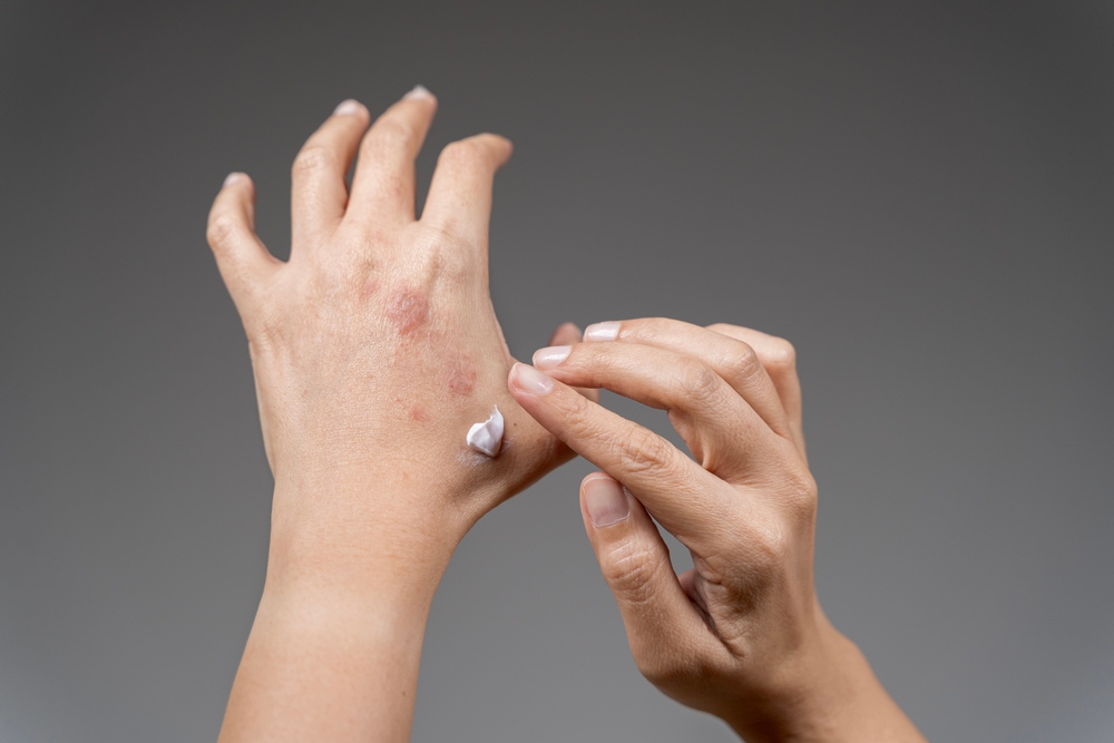 delgocitinib hand cream