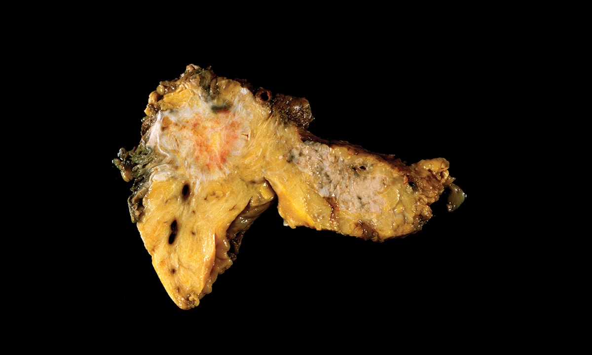 Smoking and pancreatic cancer yet another reason to quit 825