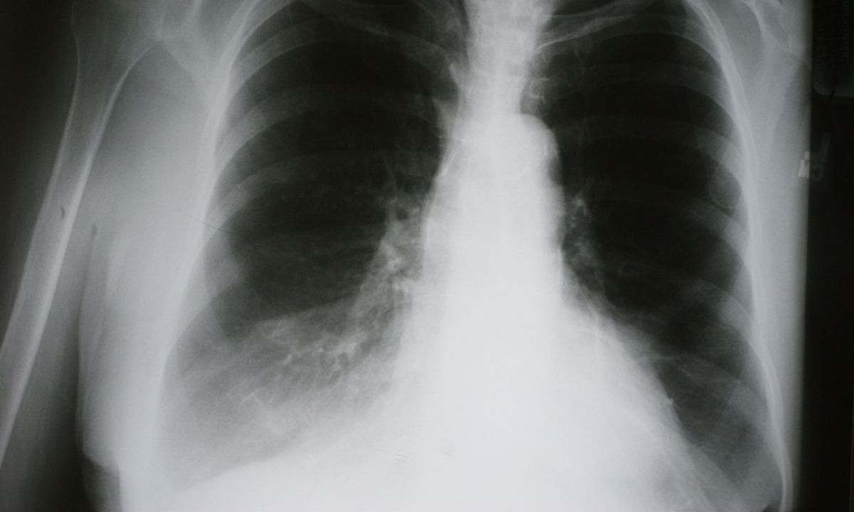 Spirometry barriers drive COPD misdiagnosis rate - Featured Image