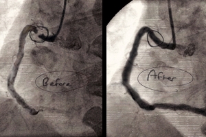 Stent