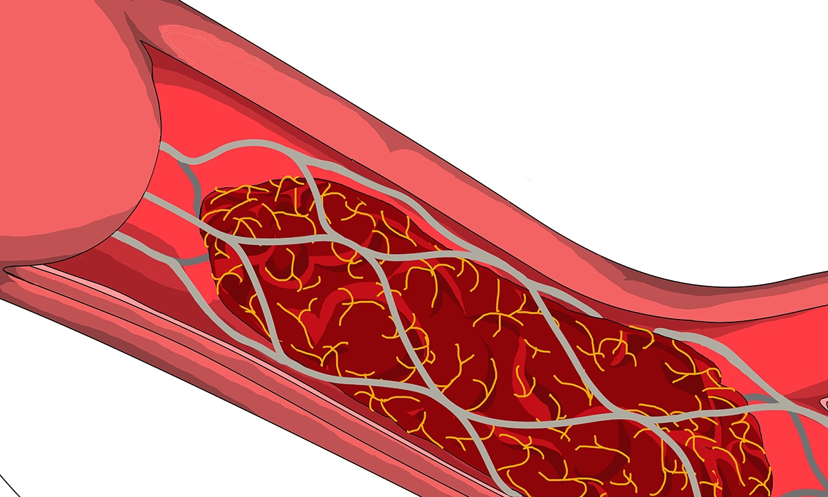 Stroke care: “tissue clock” may replace “time clock” - Featured Image