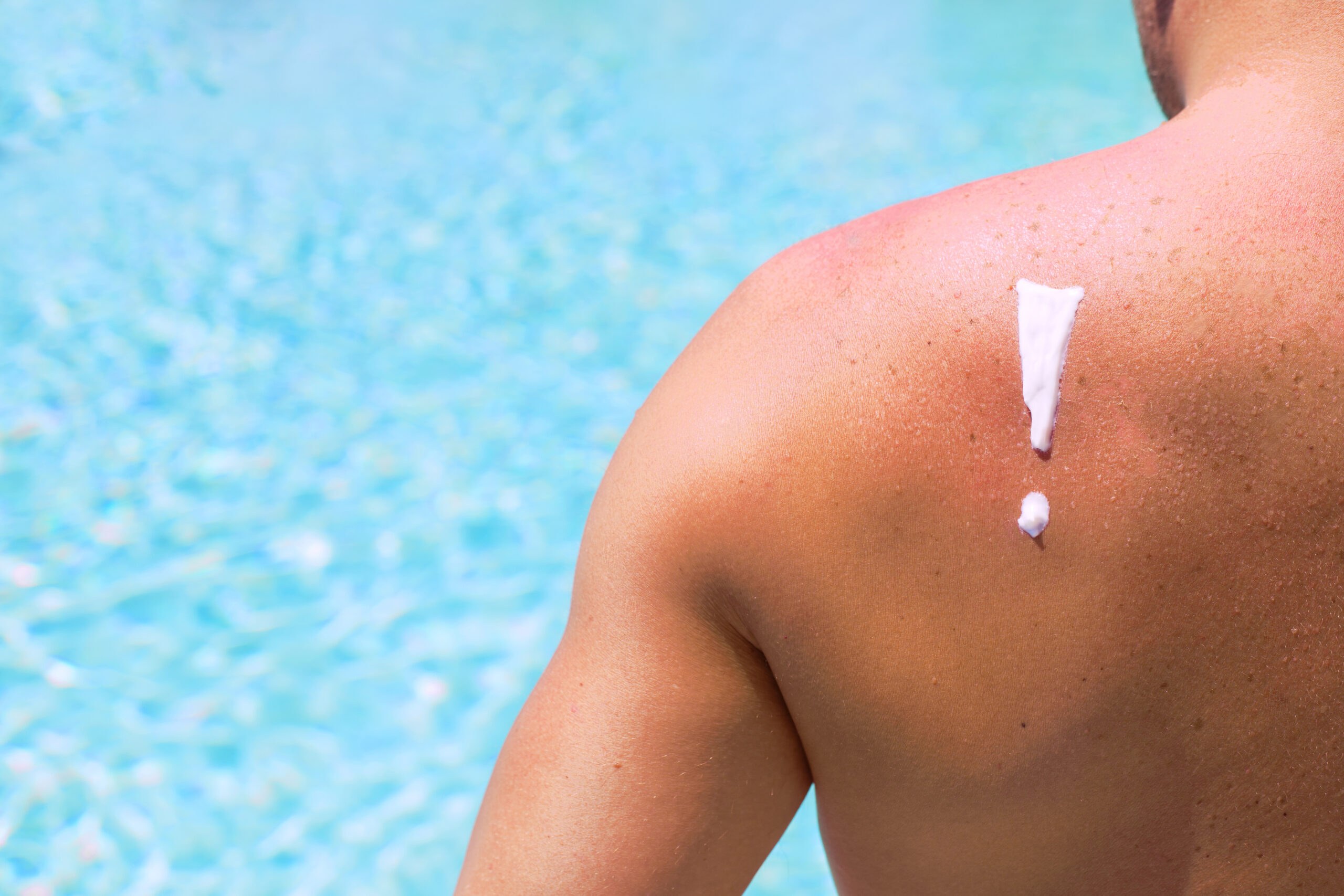 Sunburn scaled