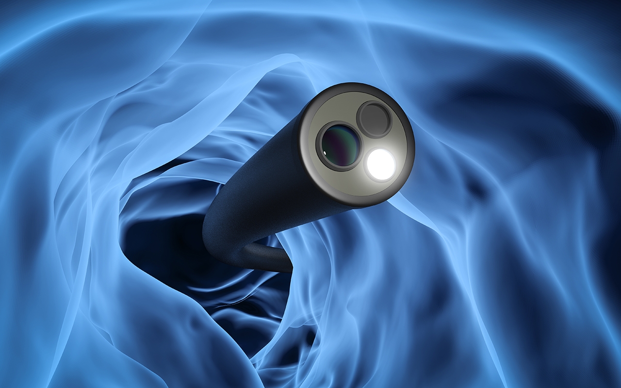 Surveillance colonoscopies: how often and who? - Featured Image