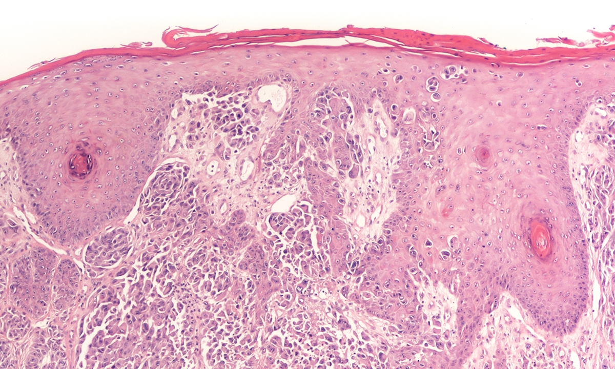 Talimogene “first ever melanoma vaccine” - Featured Image