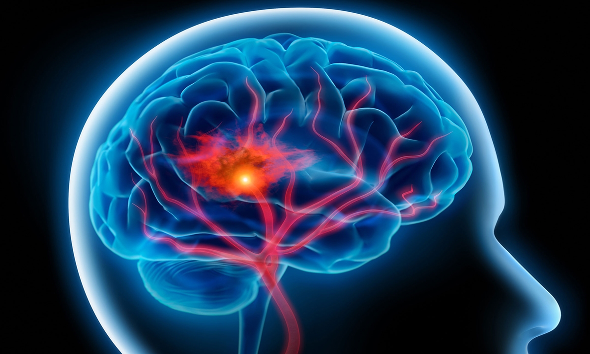 The stroke patients slipping through the cracks - Featured Image