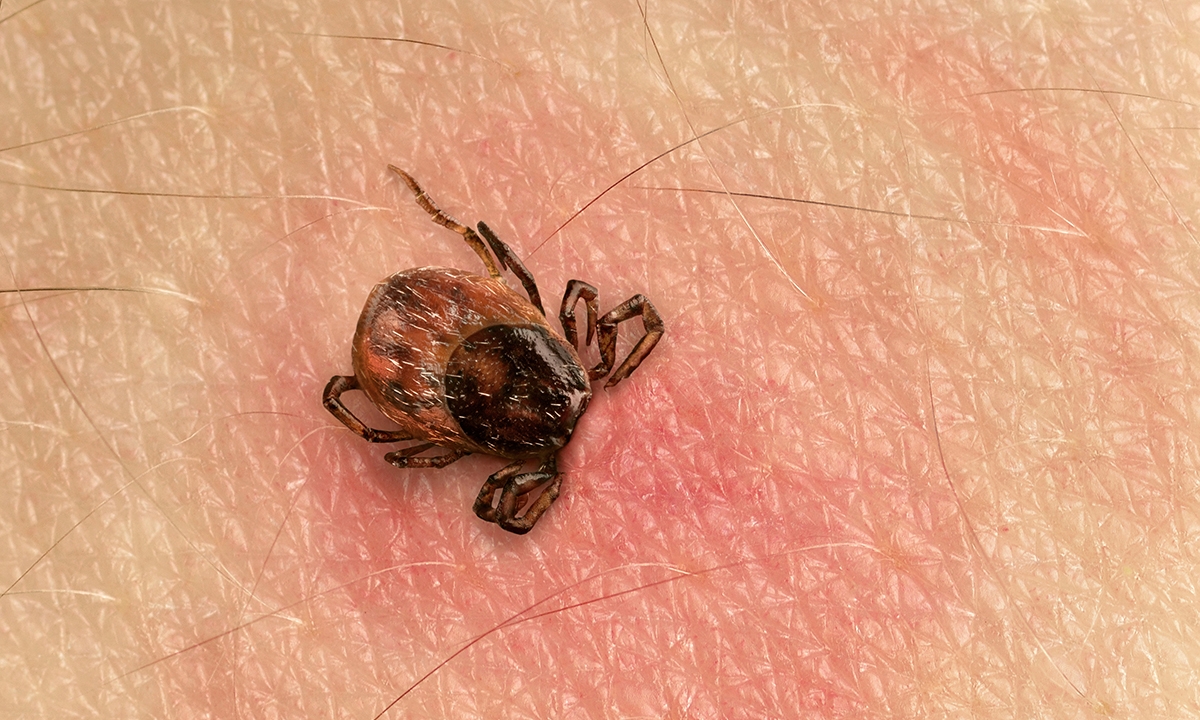 There is no locally acquired lyme disease 430