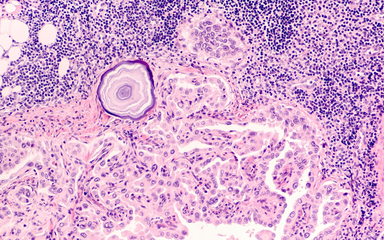 Thyroid carcinoma