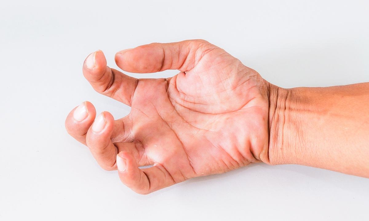 Time to extend PBS inclusions for botulinum toxin in spasticity? - Featured Image