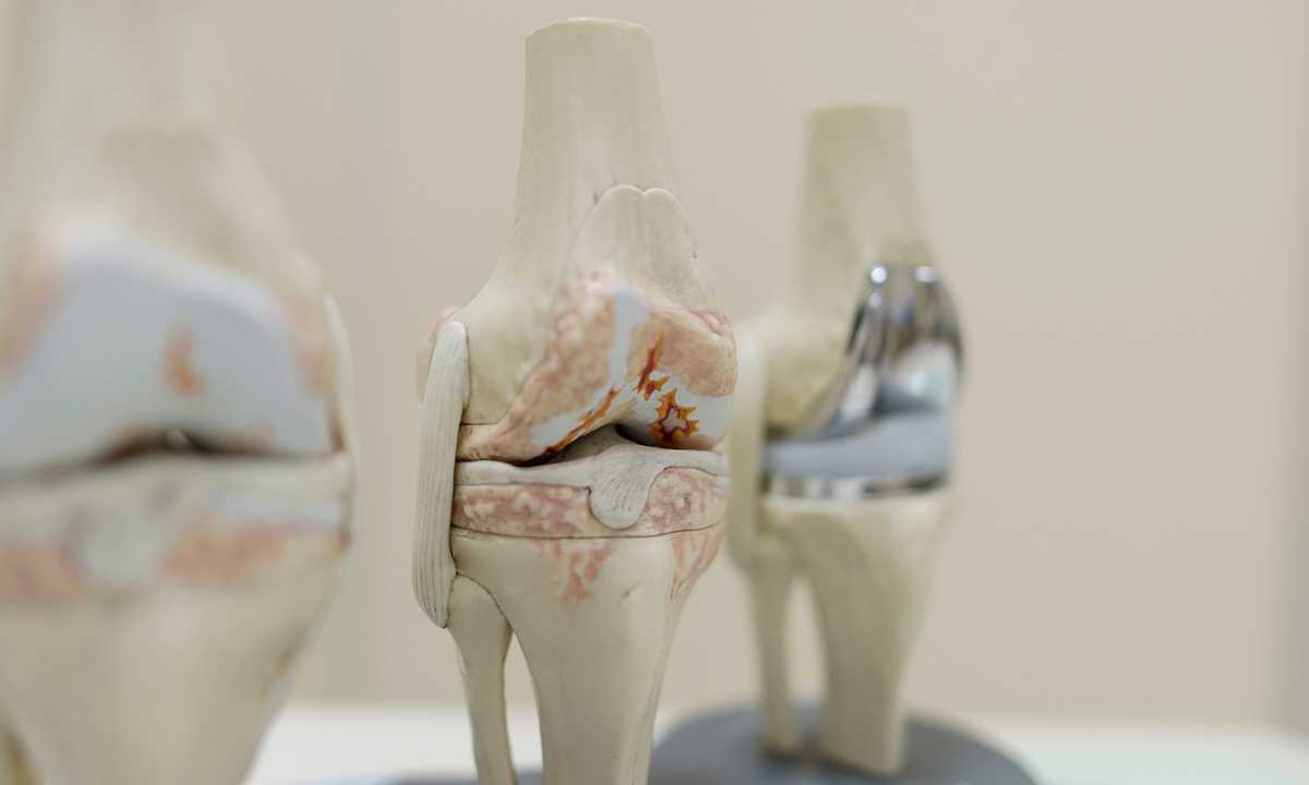 Total knee replacement who should and who shouldnt 451